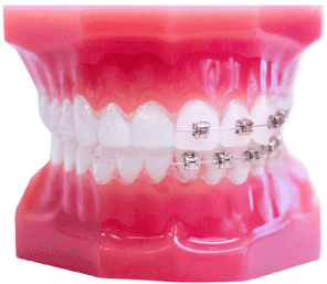 Invisible Braces compare Metal Braces In Teeth Mould Visual