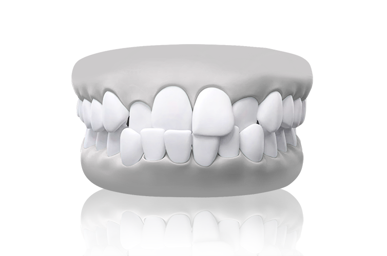 Crossbite teeth model – misalignment of dental arches