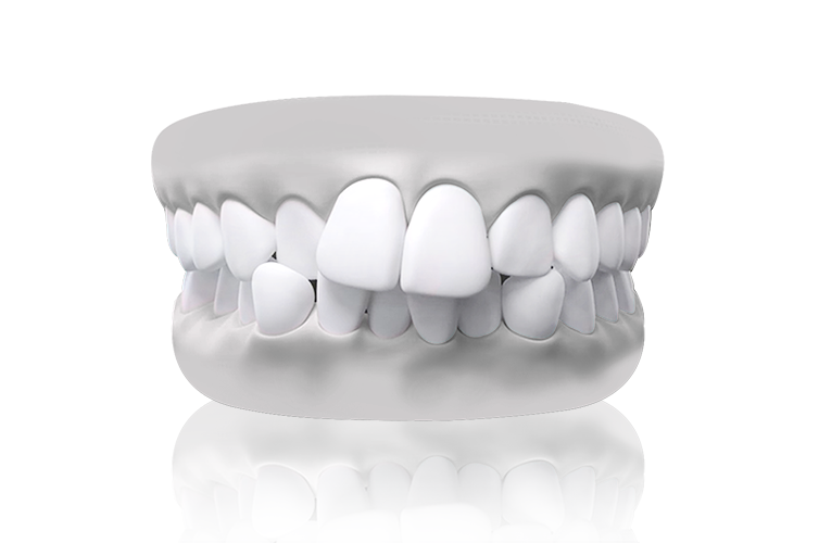 Crowded teeth model – overlapping or twisted teeth