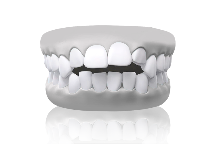 Open bite model – space between upper and lower teeth