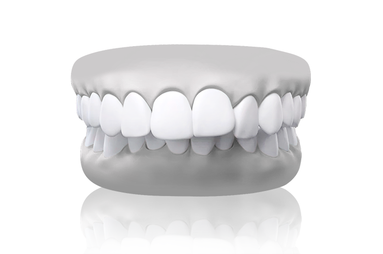 Overbite teeth illustration – upper teeth overlap lower