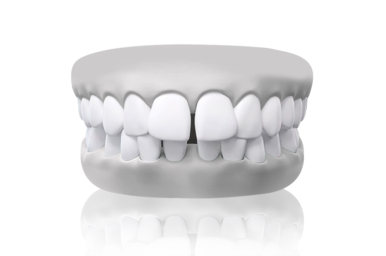 Teeth gap or spacing malocclusion diagram