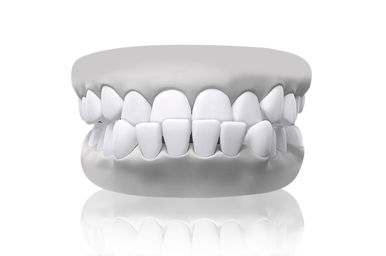 Underbite teeth illustration – lower teeth in front