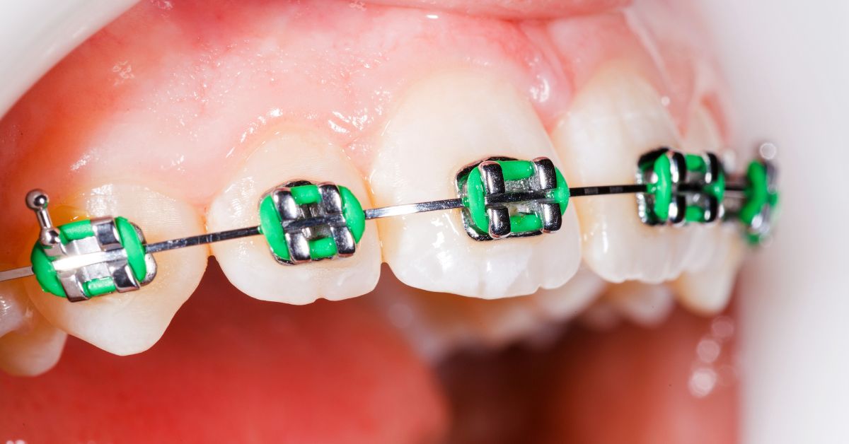 All Types of Braces and Their Prices in Malaysia: A Complete Guide