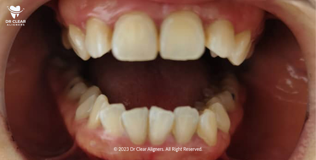 crossbite teeth problem dr clear aligners