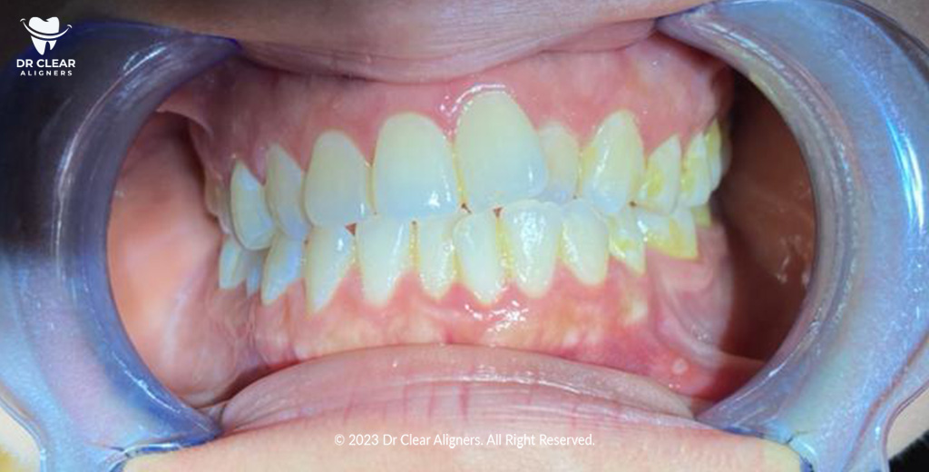 crowded teeth problem dr clear aligners