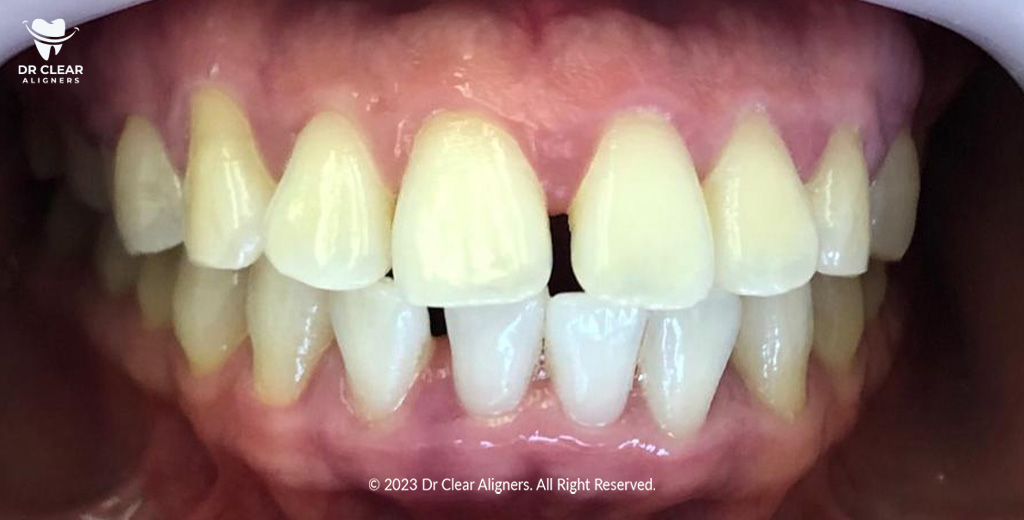 gap teeth problem dr clear aligners