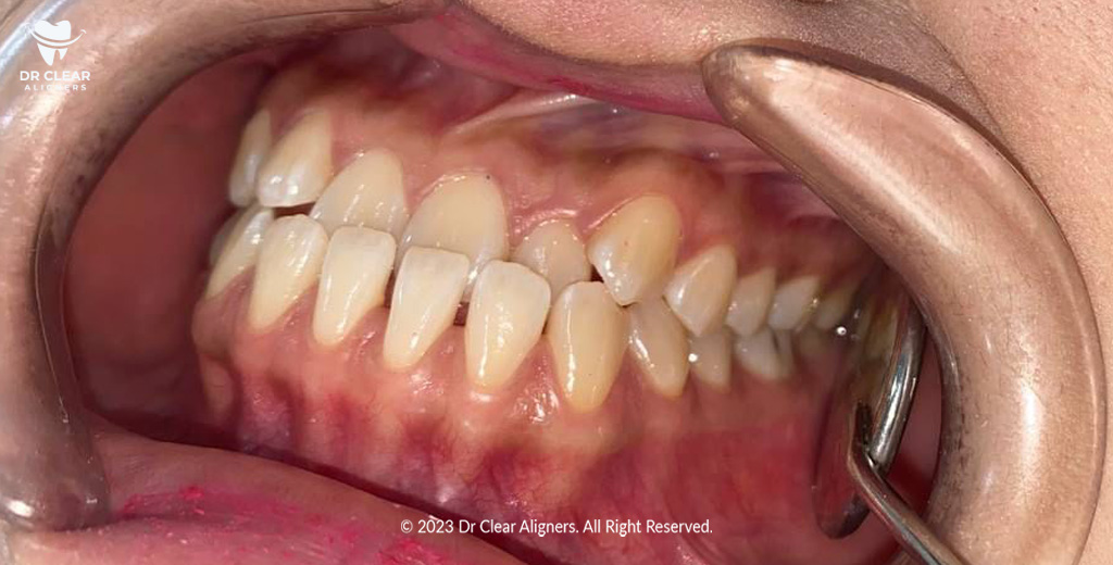 underbite teeth problem dr clear aligners