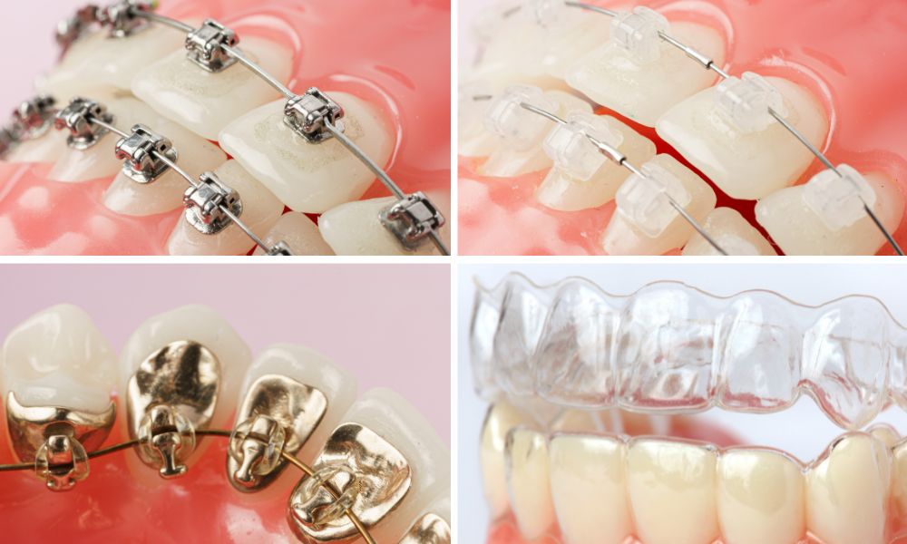 Braces: Types & How They Work