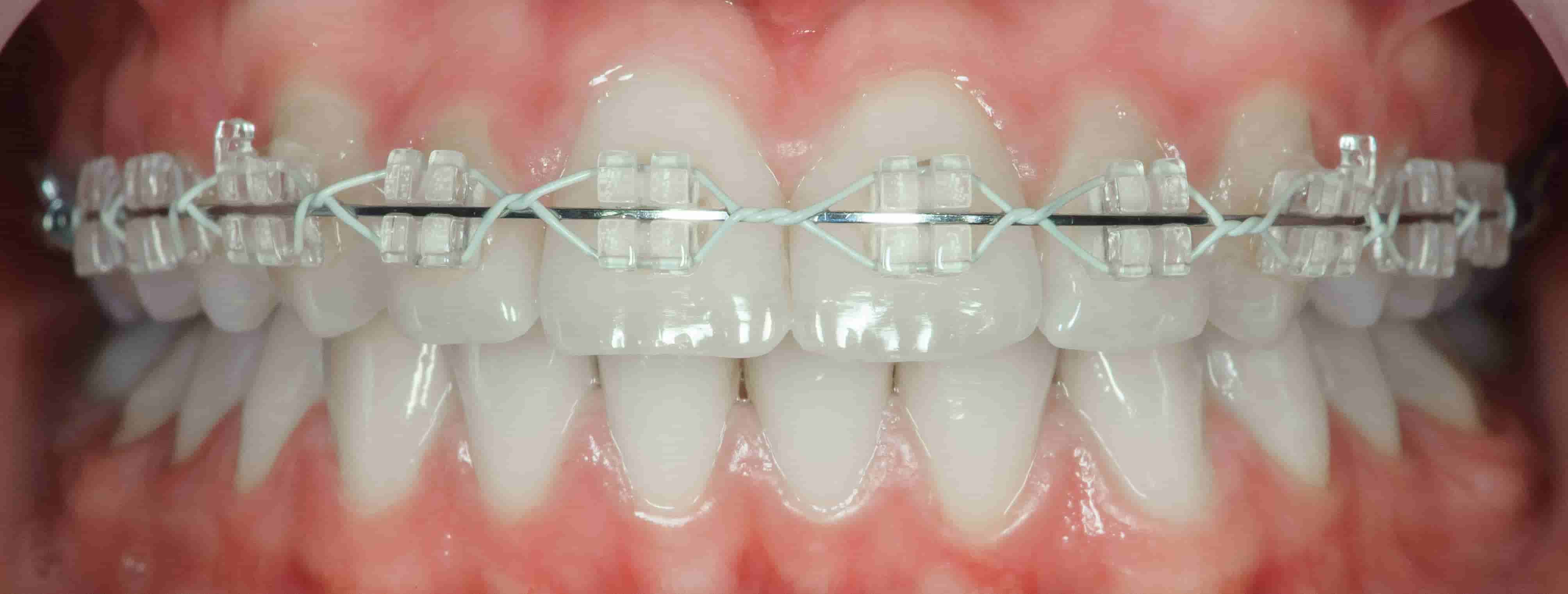 teeth with ceramic braces