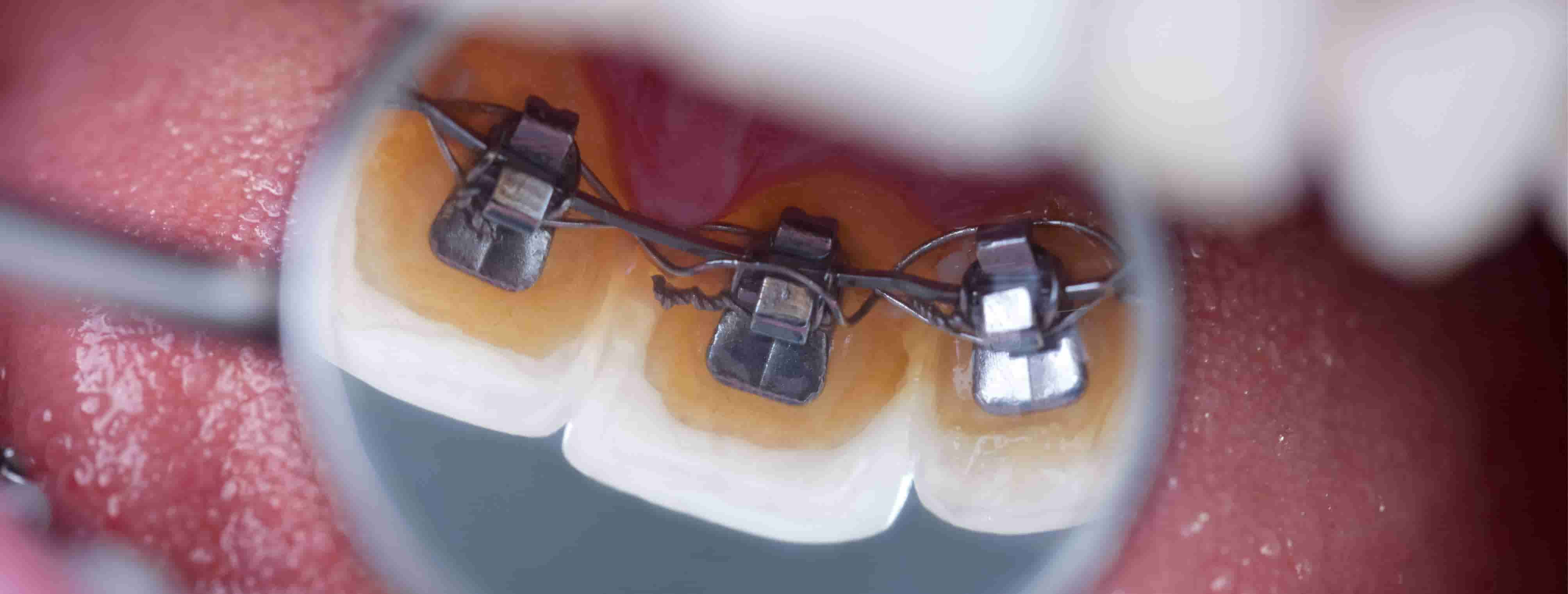 teeth with lingual braces