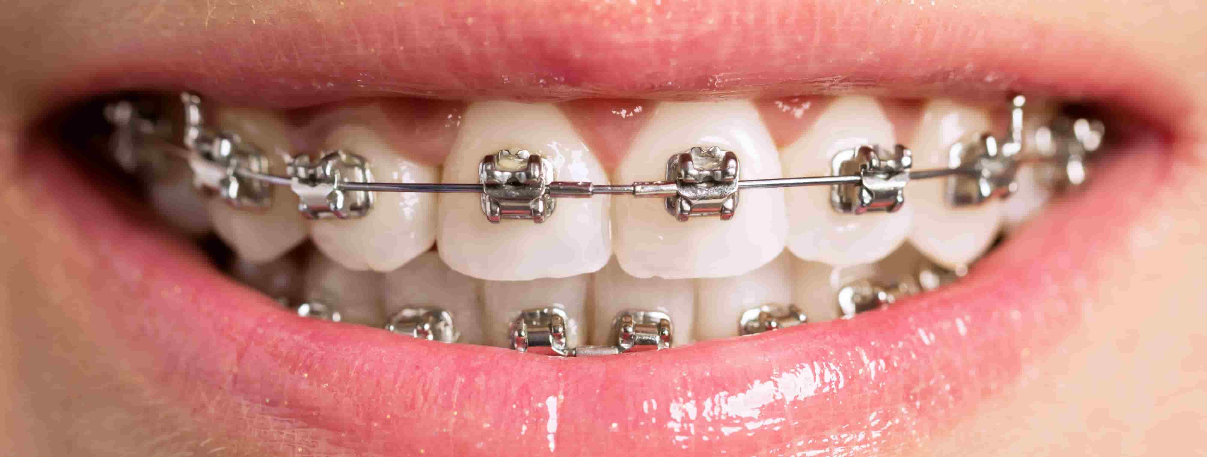 teeth with metal braces
