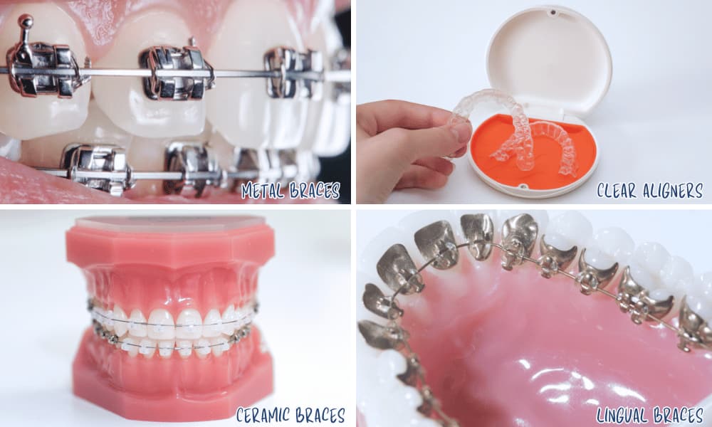 How Long Do Various Types of Braces Take to Straighten Teeth
