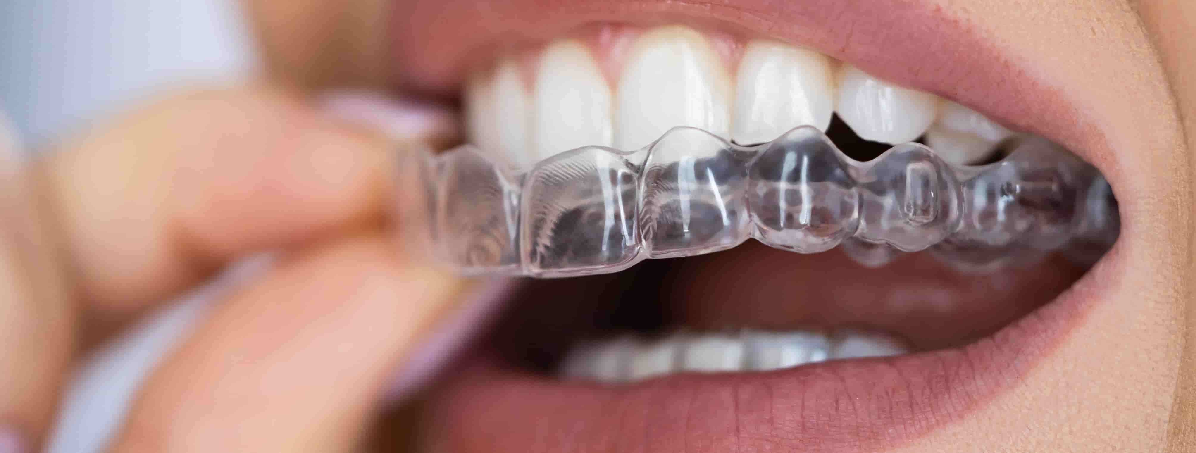 Clear aligners used for discreet teeth straightening in Malaysia
